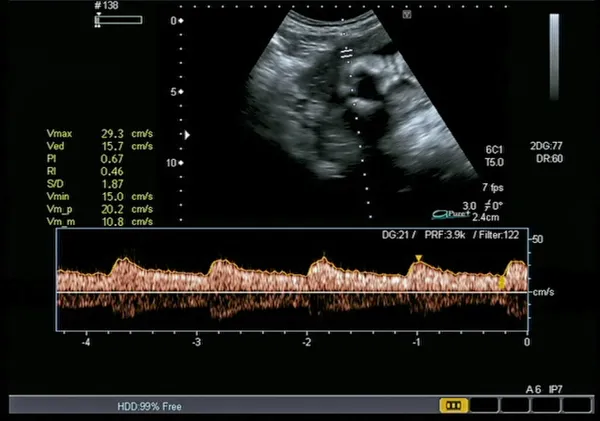 Batimento cardíaco fetal — Fotografia de Stock