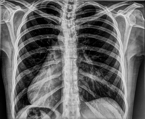 Chest x-ray — Stock Photo, Image