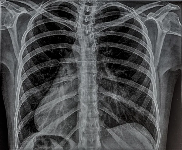 Chest x-ray — Stock Photo, Image