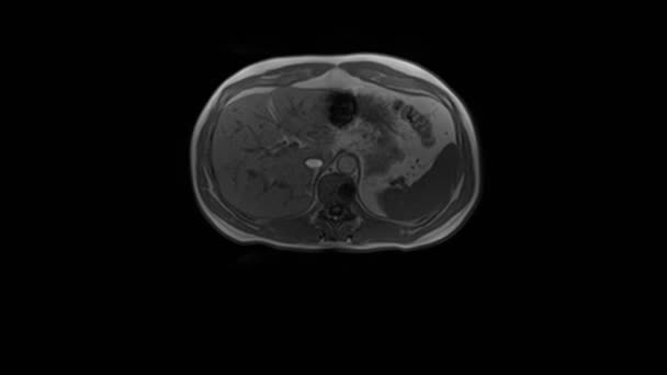 CT scan dari abdomen. Komputasi tomografi saluran pencernaan, hati dan ginjal. — Stok Video