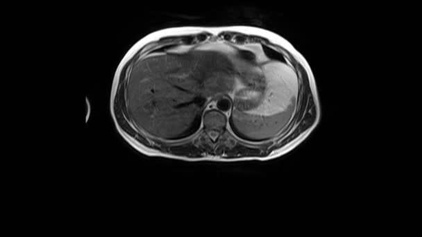 Tomografía computarizada del abdomen. Tomografía computarizada del tracto gastrointestinal, hígado y riñones. — Vídeos de Stock