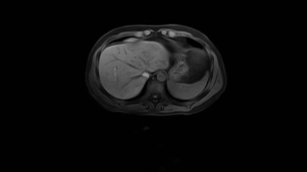 腹部的CT扫描。胃肠道、肝脏及肾脏的电脑断层扫描. — 图库视频影像