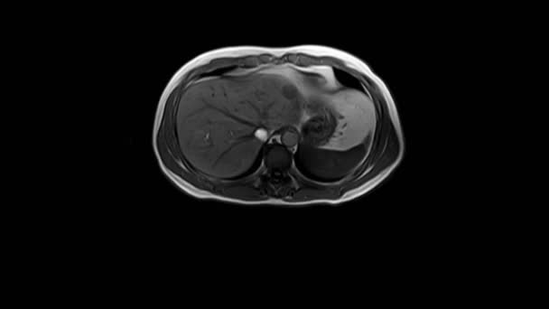 TAC ao abdómen. Tomografia computadorizada do trato gastrointestinal, fígado e rins. — Vídeo de Stock