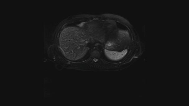 TAC voluminosa dell'addome. Tomografia computerizzata del tratto gastrointestinale, del fegato e dei reni — Video Stock