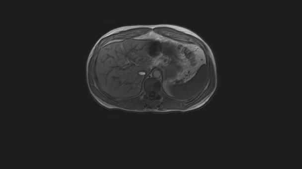 Tomografia computadorizada volumosa do abdómen. Tomografia computadorizada do trato gastrointestinal, fígado e rins — Vídeo de Stock