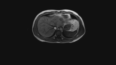 Karın bölgesinin gönüllü CT taraması. Mide, karaciğer ve böbreklerin tomografisi.