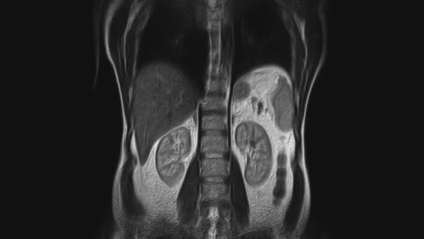 Об'ємне КТ-сканування живота. Комп'ютерна томографія шлунково кишкового тракту, печінки та нирок — стокове відео