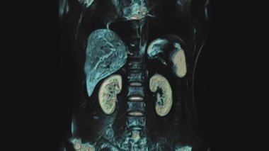 Karın bölgesinde çok renkli tomografi taraması. Mide, karaciğer ve böbreklerin tomografisi.