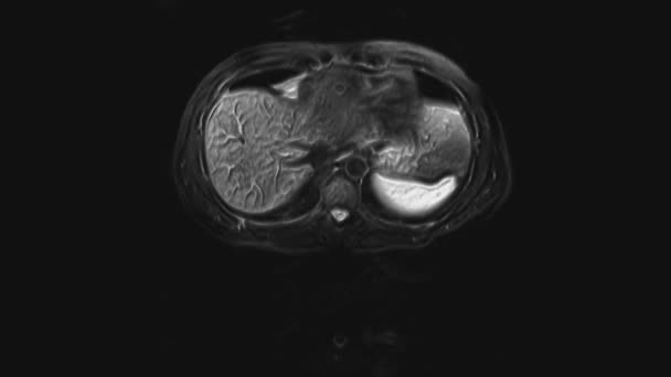 Tomografía computarizada voluminosa del abdomen. Tomografía computarizada del tracto gastrointestinal, hígado y riñones — Vídeos de Stock