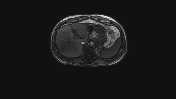 Tomografia computadorizada volumosa do abdómen. Tomografia computadorizada do trato gastrointestinal, fígado e rins — Vídeo de Stock