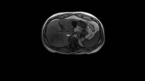 КТ-сканування живота. Комп'ютерна томографія шлунково кишкового тракту, печінки та нирок . — стокове відео