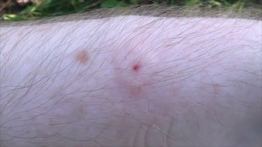 Bal arısı arı yetiştiricisinin elini soktu. Yakın plan - ısırıktan kaynaklanan iltihaplanma yeri.