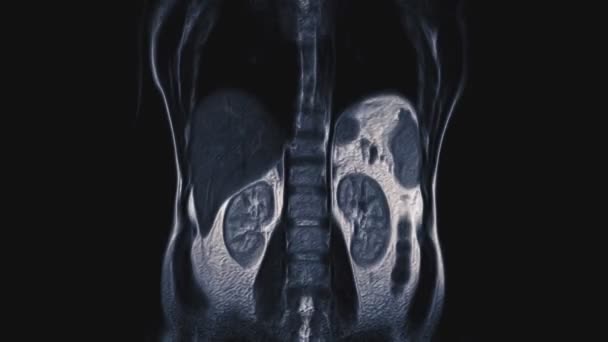 Tomografía computarizada a color voluminosa del abdomen. Tomografía computarizada del tracto gastrointestinal, hígado y riñones — Vídeos de Stock