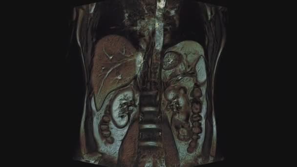 Tomografía computarizada multicolor a granel del abdomen. Tomografía computarizada del tracto gastrointestinal, hígado y riñones — Vídeo de stock