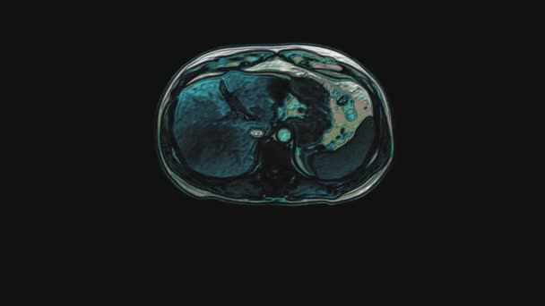 Tomografía computarizada multicolor a granel del abdomen. Tomografía computarizada del tracto gastrointestinal, hígado y riñones — Vídeos de Stock