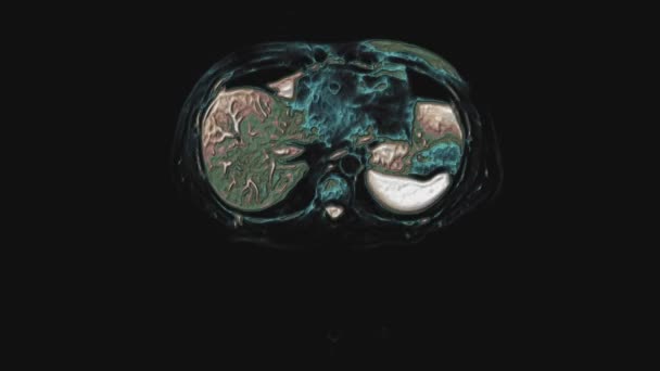 Scanare CT multicoloră în vrac a abdomenului. Tomografia computerizată a tractului gastro-intestinal, ficatului și rinichilor — Videoclip de stoc