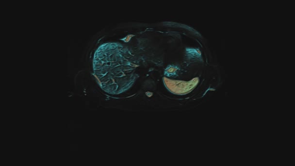 Tomografía computarizada multicolor a granel del abdomen. Tomografía computarizada del tracto gastrointestinal, hígado y riñones — Vídeo de stock