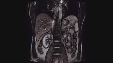 Karın röntgeni için gönüllü renk tomografisi. Mide, karaciğer ve böbreklerin tomografisi..