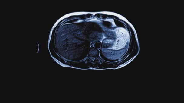 腹部大面积彩色Ct扫描 胃肠道 肝脏及肾脏的电脑断层扫描 — 图库视频影像