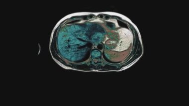 Karın bölgesinde çok renkli tomografi taraması. Mide, karaciğer ve böbreklerin tomografisi..