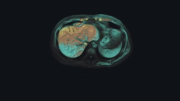 Tomografia Computadorizada Multicolorida Massa Abdômen Tomografia Computadorizada Trato Gastrointestinal Fígado — Vídeo de Stock