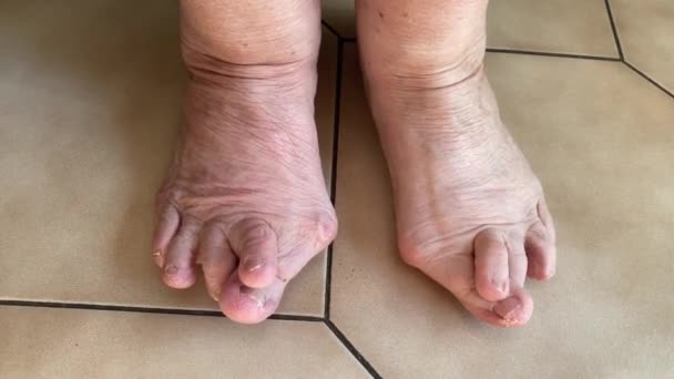 Woman Feet Bunion Hammer Toes Indoors Tie Floor Tries Move — Vídeos de Stock