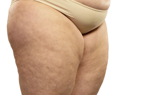 Frau zeigt ihre Cellulite — Stockfoto