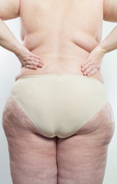 Kadın selülitini gösteriyor