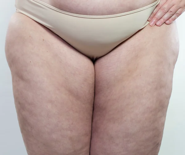 Vrouw toont haar cellulitis — Stockfoto