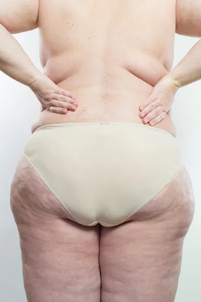 Femme montrant sa cellulite — Photo