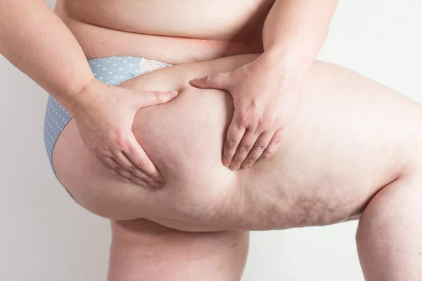 Woman showing her cellulite — Stock Photo, Image