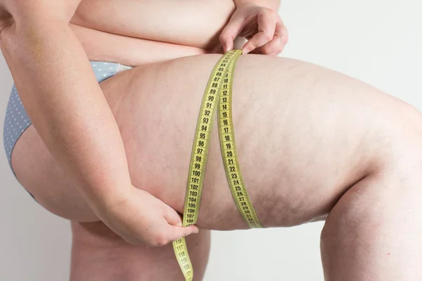 Woman showing her cellulite — Stock Photo, Image