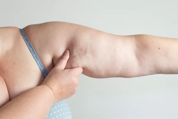 Mujer mostrando su celulitis —  Fotos de Stock