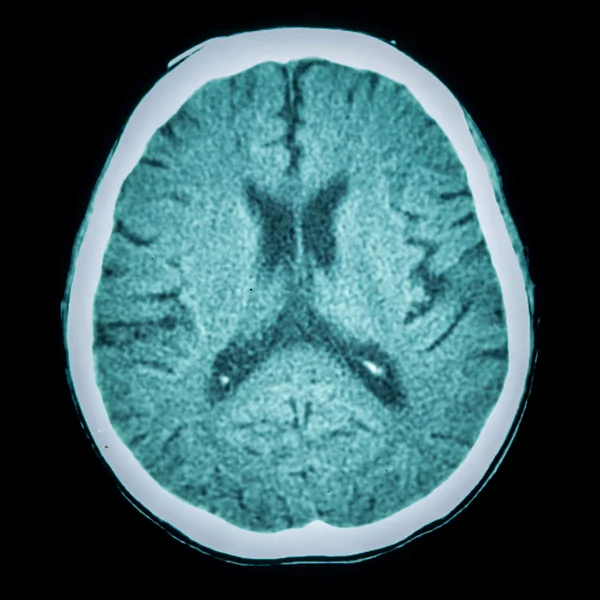 Datortomografi av hjärnan visar ischemisk Stroke och hemorragisk Stroke