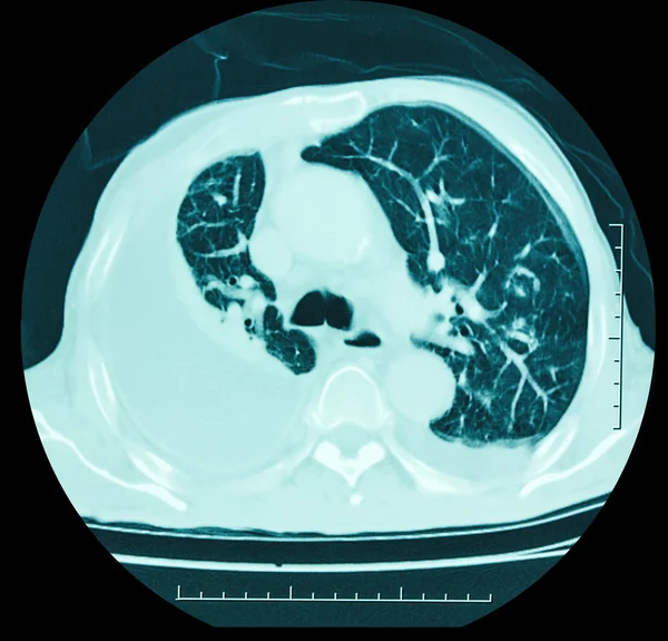 X-ray, akciğer — Stok fotoğraf