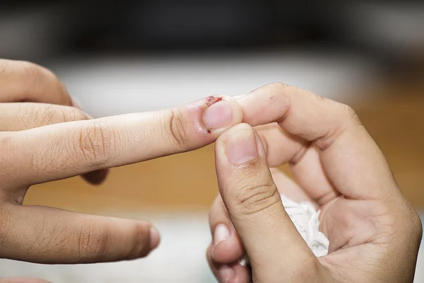 yaralar, ısırıkları çivi