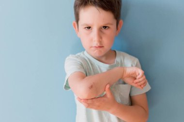Caucasian boy with grazed hand on a blue background with copy space