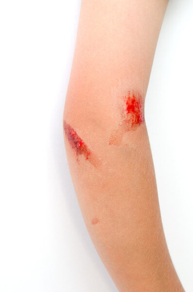 Child with arm injury