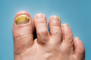 Onychomycosis, patojenik mantarların neden olduğu bir tırnak hastalığı..