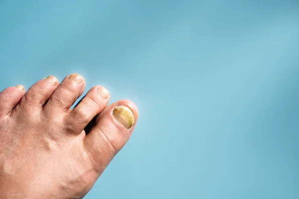 Onychomycosis, patojenik mantarların sebep olduğu bir tırnak hastalığı. Metin için alanı kopyala