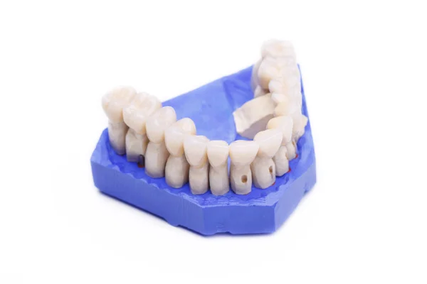 Proteza zębów na białym tle — Zdjęcie stockowe