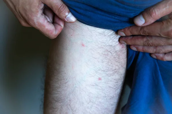 在亲密区域附近男人腿上的皮疹有荨麻疹症状的人 — 图库照片