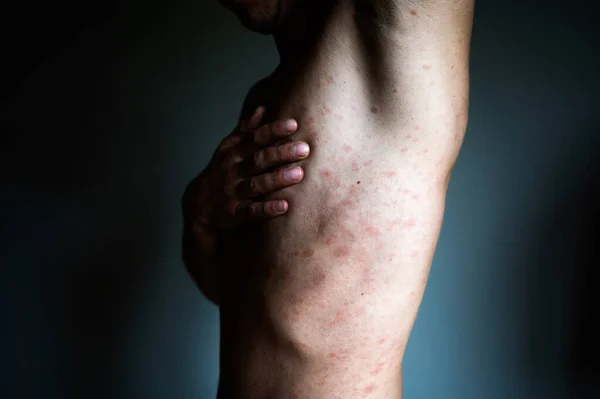 Corpo Dell Uomo Adulto Macchiato Brufolo Rosso Eruzione Cutanea Varicella — Foto Stock