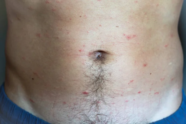 成年男子身上有水痘或水痘带状疱疹病毒引起的斑点 红粉刺和气泡疹 疾病后的医疗并发症 — 图库照片
