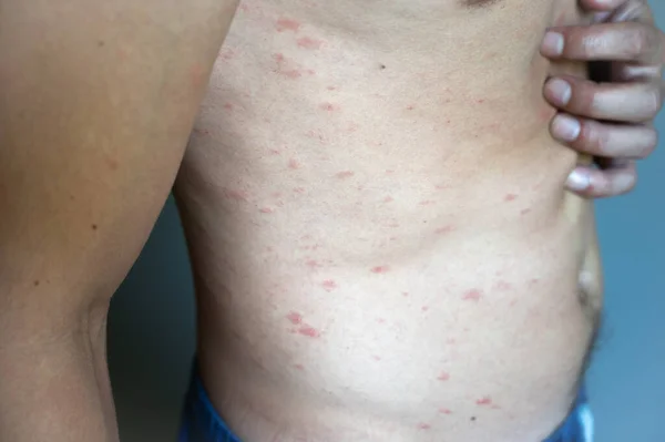 Atopic eczema allergy texture of ill human skin. Man with symptoms of itchy urticaria.