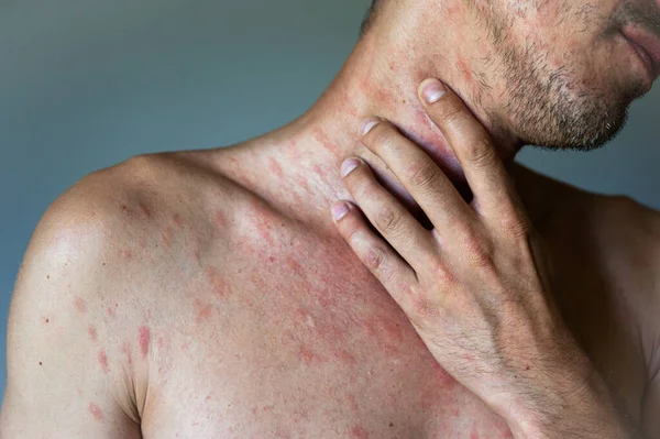 成年男子身上有水痘或水痘带状疱疹病毒引起的斑点 红粉刺和气泡疹 有荨麻疹症状的人 — 图库照片