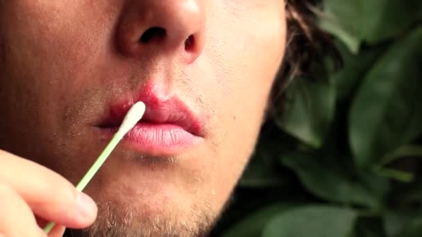 Trattamento dell'herpes sul labbro con una crema speciale — Video Stock