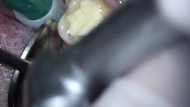 Dişçilik. Mikroskop altında video çekimi. Eski dolguların çıkarılması ve alt dişlerden top şeklinde bir burgerle çıkarılması. — Stok video