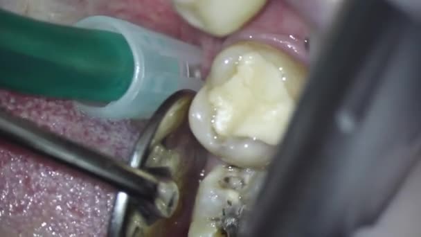 歯医者さん。顕微鏡で撮影しました。古い充填とボール型のバーで下の歯からのキャリーの除去 — ストック動画