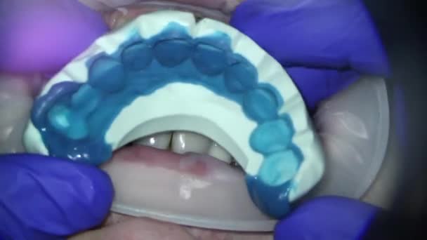Tandvård. Videofilmning under mikroskop. få formen av patienterna tänder med silikon — Stockvideo